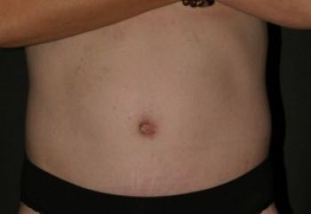 Tummy Tuck - Before & After - Dr. Placik