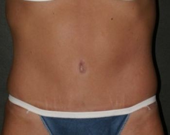 Tummy Tuck - Before & After - Dr. Placik