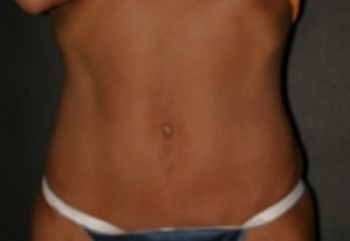 Tummy Tuck - Before & After - Dr. Placik