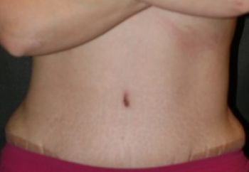 Tummy Tuck - Before & After - Dr. Placik