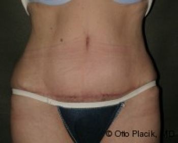 Tummy Tuck - Before & After - Dr. Placik