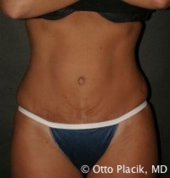 Tummy Tuck - Before & After - Dr. Placik