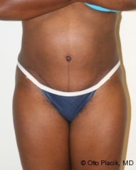 Tummy Tuck - Before & After - Dr. Placik