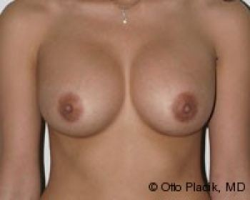 Before & After Breast Augmentation Gallery - Before & After - Dr. Placik