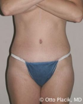 Tummy Tuck - Before & After - Dr. Placik