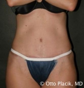 Tummy Tuck - Before & After - Dr. Placik