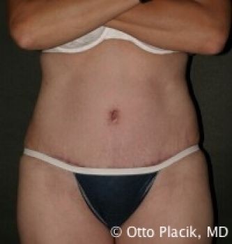 Tummy Tuck - Before & After - Dr. Placik