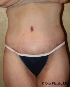 Tummy Tuck - Before & After - Dr. Placik