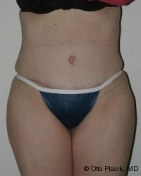 Tummy Tuck Chicago