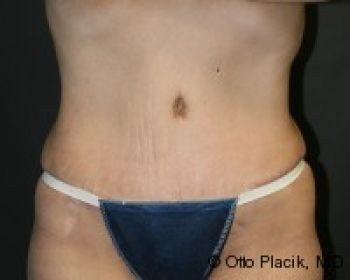 Tummy Tuck - Before & After - Dr. Placik