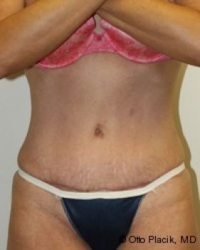 Tummy Tuck - Before & After - Dr. Placik