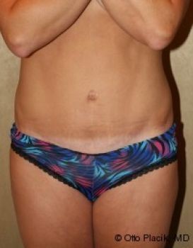 Tummy Tuck - Before & After - Dr. Placik