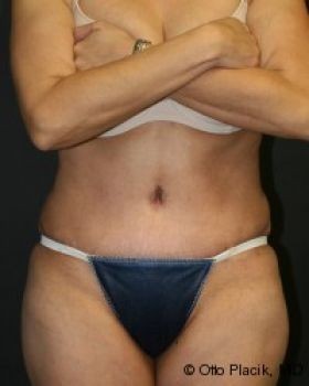 Tummy Tuck - Before & After - Dr. Placik