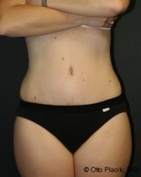 Tummy Tuck - Before & After - Dr. Placik