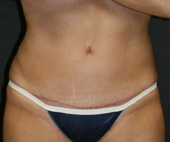 Tummy Tuck - Before & After - Dr. Placik