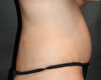 Tummy Tuck - Before & After - Dr. Placik