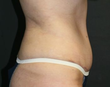 Tummy Tuck