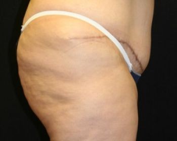 Liposuction Chicago