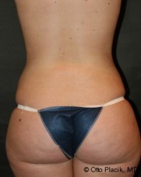 Liposuction - Before & After - Dr. Placik