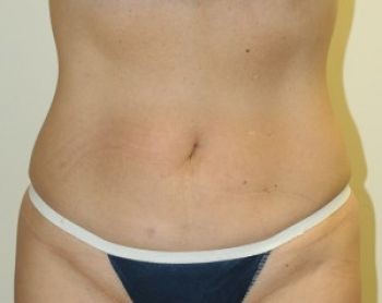 Liposuction - Before & After - Dr. Placik