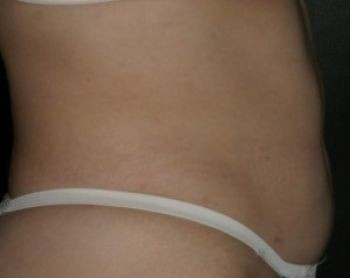 Liposuction - Before & After - Dr. Placik