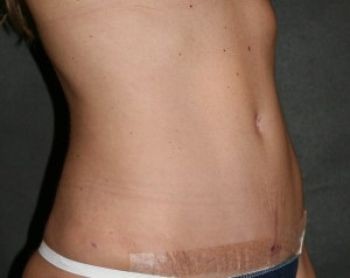 Liposuction - Before & After - Dr. Placik