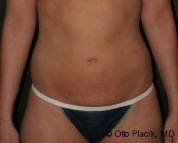 Liposuction - Before & After - Dr. Placik