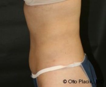 Liposuction - Before & After - Dr. Placik