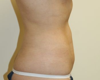 Liposuction - Before & After - Dr. Placik