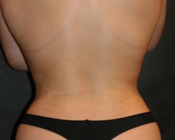 Liposuction - Before & After - Dr. Placik