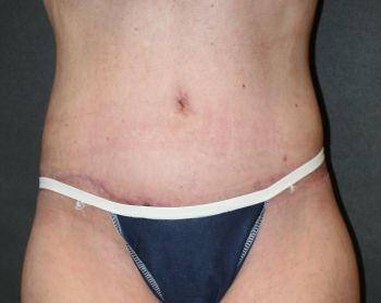 Liposuction Chicago