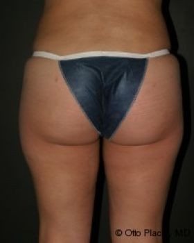 Butt Augmentation - Before & After - Dr. Placik