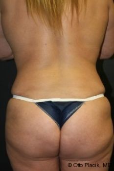 Butt Augmentation - Before & After - Dr. Placik