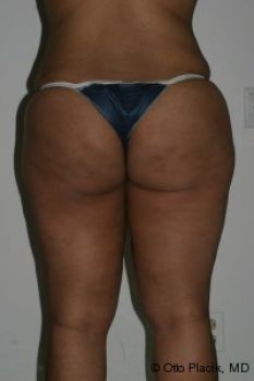 Butt Augmentation - Before & After - Dr. Placik