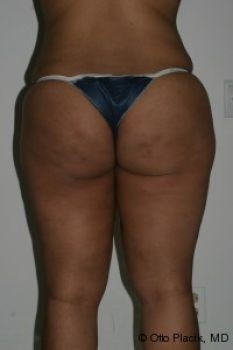 Butt Augmentation - Before & After - Dr. Placik