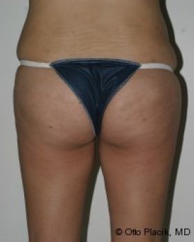 Butt Augmentation - Before & After - Dr. Placik