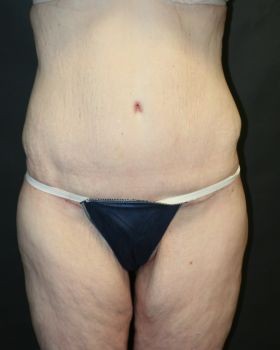 Thigh Lift - Before & After - Dr. Placik