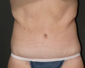 Body Lift - Before & After - Dr. Placik