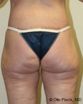 Body Lift - Before & After - Dr. Placik