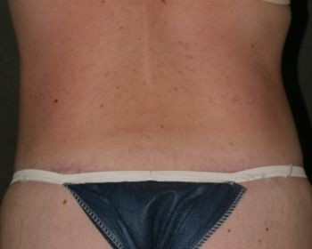 Body Lift - Before & After - Dr. Placik