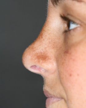 Rhinoplasty - Before & After - Dr. Placik