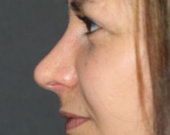 Rhinoplasty - Before & After - Dr. Placik