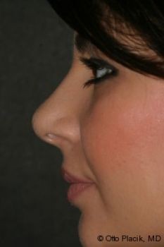 Rhinoplasty - Before & After - Dr. Placik