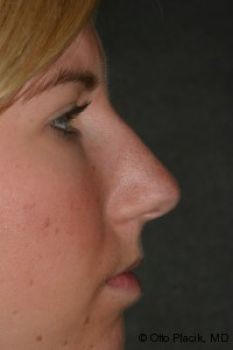 Rhinoplasty - Before & After - Dr. Placik