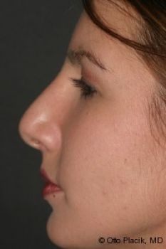 Rhinoplasty - Before & After - Dr. Placik