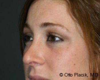 Rhinoplasty Chicago