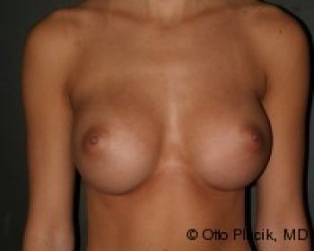 Before & After Breast Augmentation Gallery - Before & After - Dr. Placik