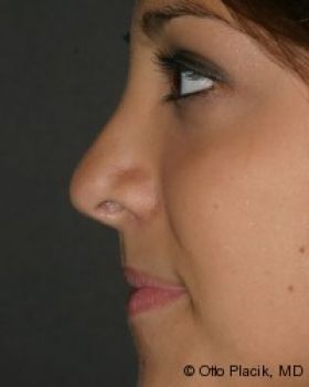 Rhinoplasty - Before & After - Dr. Placik