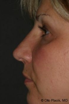 Rhinoplasty - Before & After - Dr. Placik