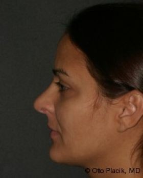 Rhinoplasty - Before & After - Dr. Placik